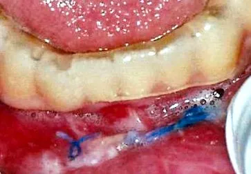 ajak papilloma alsó