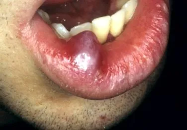 alsó ajak papilloma