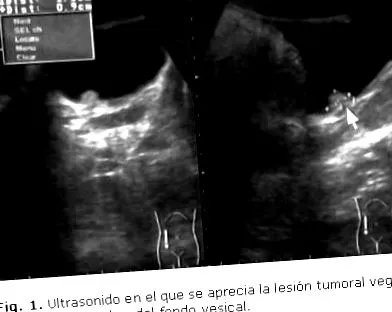 urothelialis papilloma