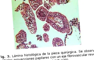 papilloma hólyag