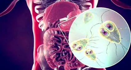 giardia