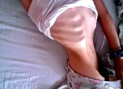 anorexiás