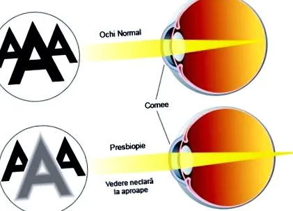 presbyopia