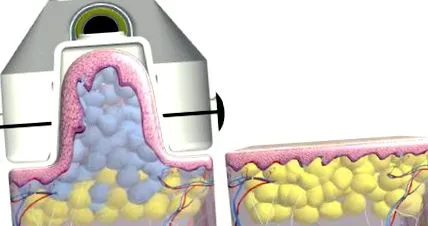 kriolipolízissel test