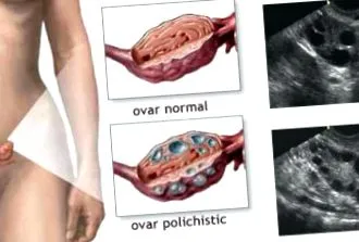 polycystických