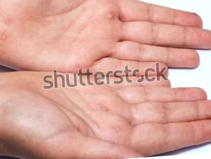 симптоми