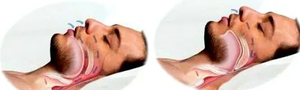 синдром спиење