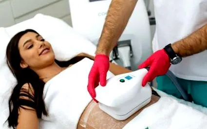 cryolipolysis локализирано