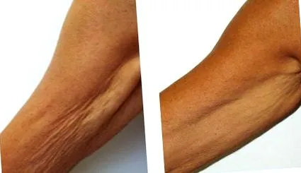 varipulse