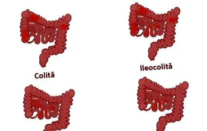 crohn-kór