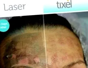 tixel dermato-esztétikai