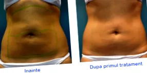 кожата разтягане