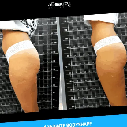 антицелулит слабеење
