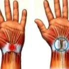 carpalis
