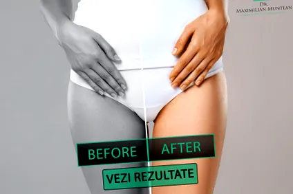 közösülés során vaginoplasztika