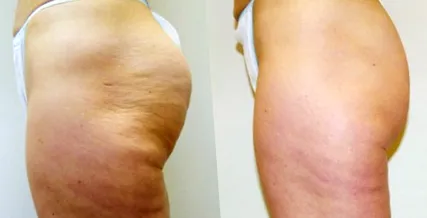 velashape