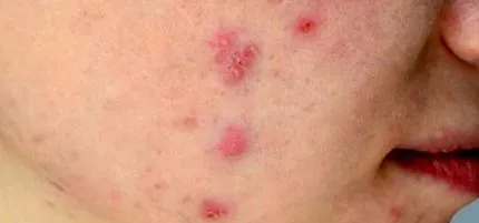 proesthetic boka
