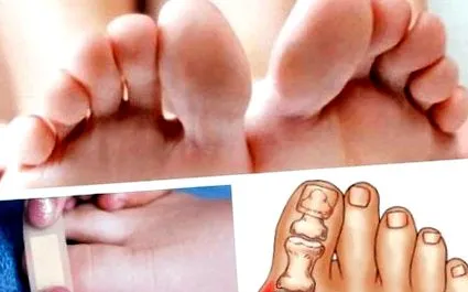 lábujjkörülmények lábujjkörülmények