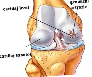 osteoarthritisje