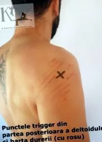 deltoid fájdalom