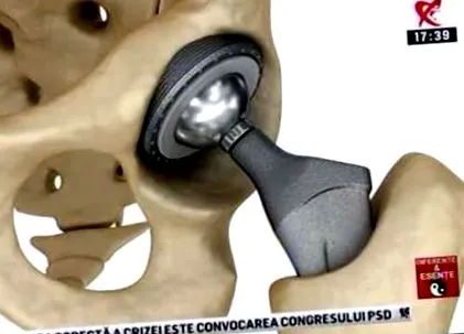 osteoarthritis kezelése