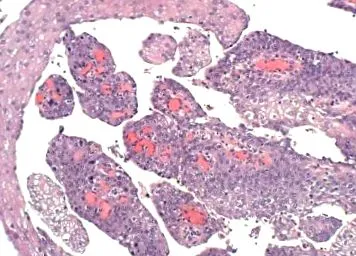 húgyhólyag papilloma