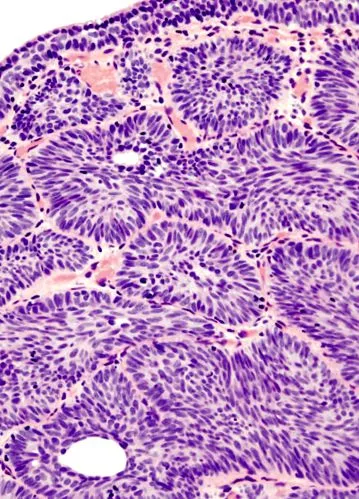 urothelialis urothelialis