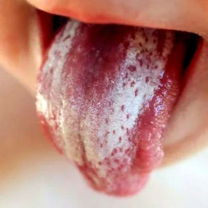 candida