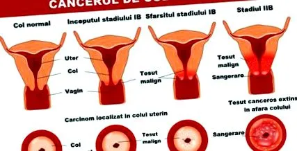 лечение стадиране