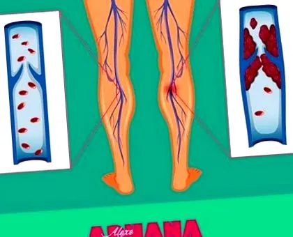 gyógymódok hígításához hígításának