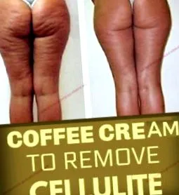 cellulit