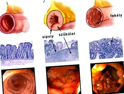 curăță intestinele