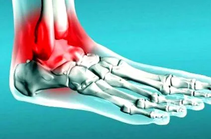 osteochondrosisban