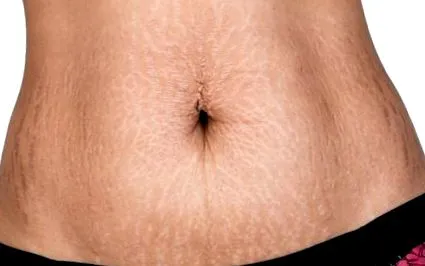 diastasis
