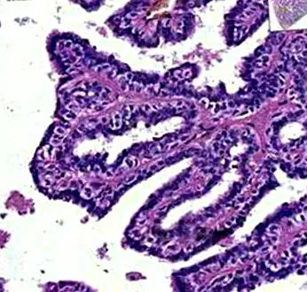 intraductalis papilloma
