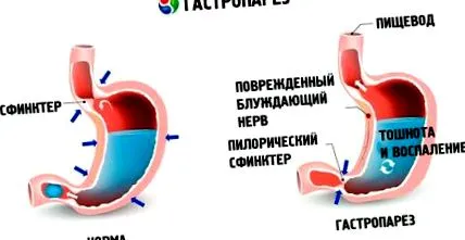 гастропареза