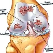 osteoarthritis