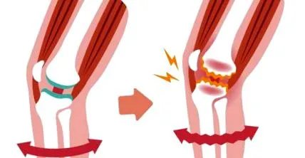 osteoarthritis