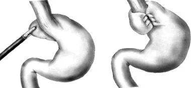 hiatal