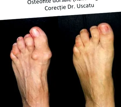 osteoarthritis