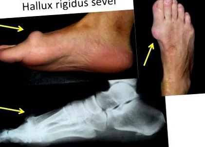 osteoarthritis