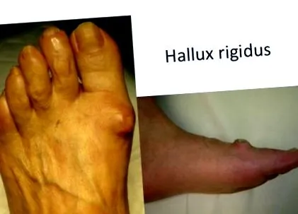 hallux