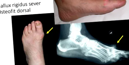 hallux