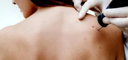 брадавица брадавица