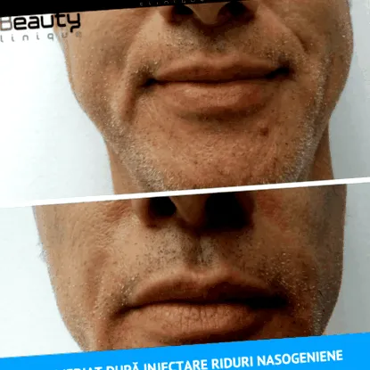 киселина инјектирање