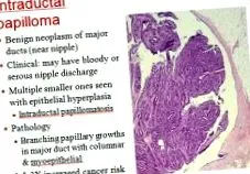 papilloma intraductalis