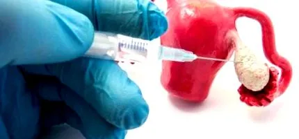 ръководство pcos