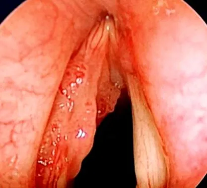 bevacizumab