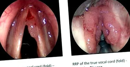 papillomatosis bevacizumab
