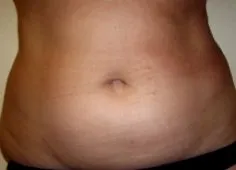 zsírleszívás